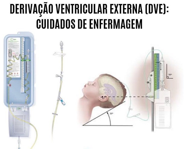 Plano de Saúde Deve Custear Cirurgia de Derivação Ventrículo-Amniótica?
